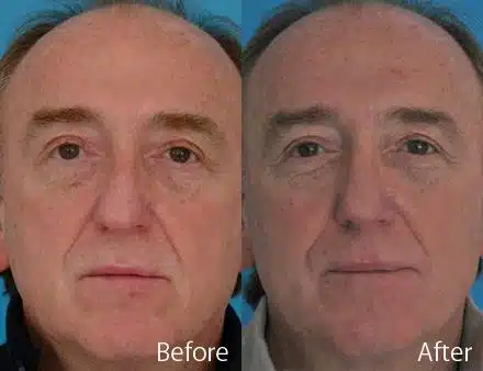 Droopy Nose Before and After Photos in Sewell, NJ, Patient 7071