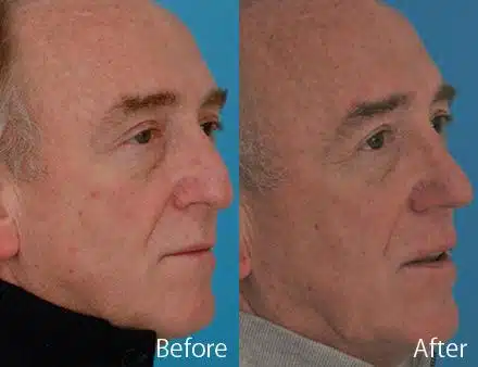 Droopy Nose Before and After Photos in Sewell, NJ, Patient 7071