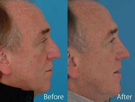 Droopy Nose Before and After Photos in Sewell, NJ, Patient 7071