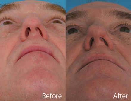 Droopy Nose Before and After Photos in Sewell, NJ, Patient 7071