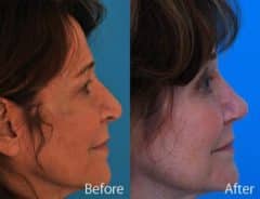 Droopy Nose Before and After Photos in Sewell, NJ, Patient 7074