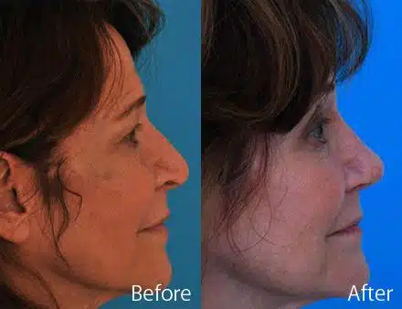 Droopy Nose Before and After Photos in Sewell, NJ, Patient 7074