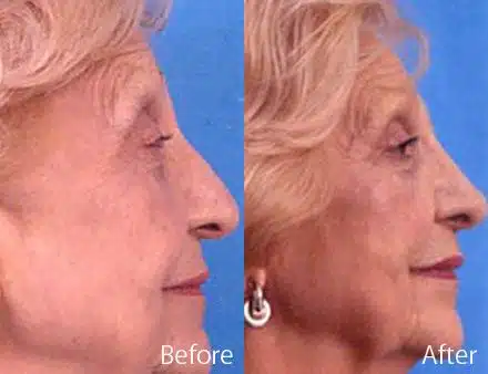 Droopy Nose Before and After Photos in Sewell, NJ, Patient 7078