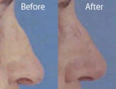 Droopy Nose Before and After Photos in Sewell, NJ, Patient 7082