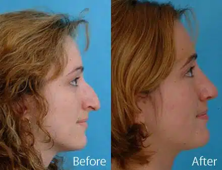 Droopy Nose Before and After Photos in Sewell, NJ, Patient 7087