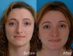 Droopy Nose Before and After Photos in Sewell, NJ, Patient 7087