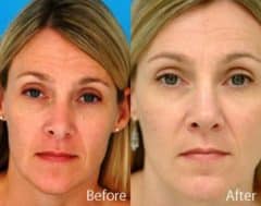 Droopy Nose Before and After Photos in Sewell, NJ, Patient 7090