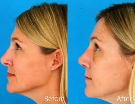 Droopy Nose Before and After Photos in Sewell, NJ, Patient 7090