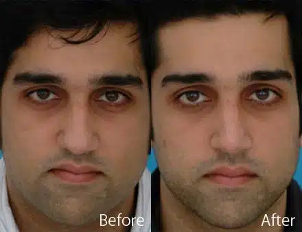 Droopy Nose Before and After Photos in Sewell, NJ, Patient 7093