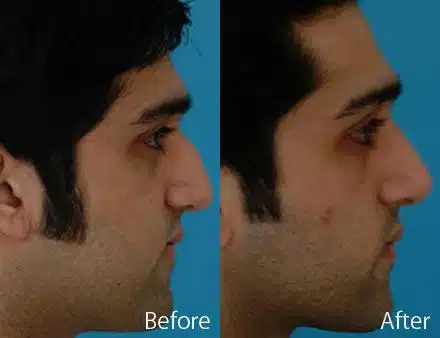 Droopy Nose Before and After Photos in Sewell, NJ, Patient 7093