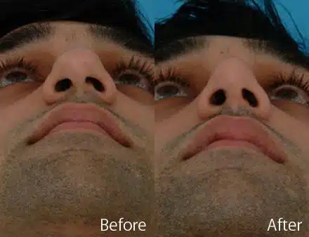 Droopy Nose Before and After Photos in Sewell, NJ, Patient 7093