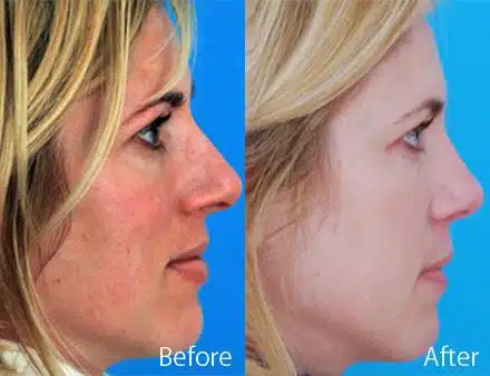 Droopy Nose Before and After Photos in Sewell, NJ, Patient 7099