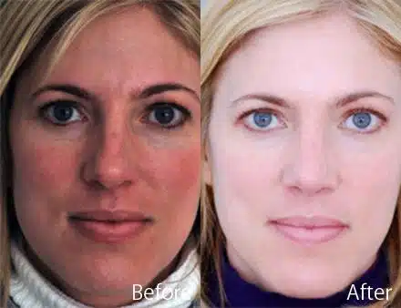 Droopy Nose Before and After Photos in Sewell, NJ, Patient 7099