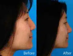 Ethnic Rhinoplasty Before and After Photos in Sewell, NJ, Patient 7139