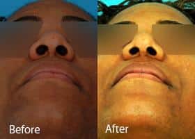 Ethnic Rhinoplasty Before and After Photos in Sewell, NJ, Patient 7141