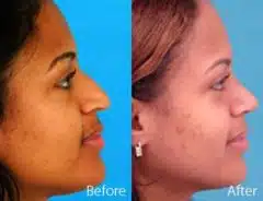 Ethnic Rhinoplasty Before and After Photos in Sewell, NJ, Patient 7145