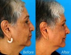 Ethnic Rhinoplasty Before and After Photos in Sewell, NJ, Patient 7149