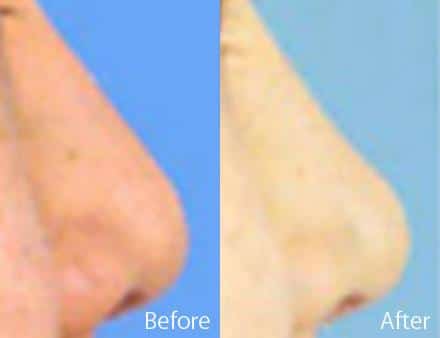 Ethnic Rhinoplasty Before and After Photos in Sewell, NJ, Patient 7151