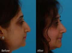 Ethnic Rhinoplasty Before and After Photos in Sewell, NJ, Patient 7153