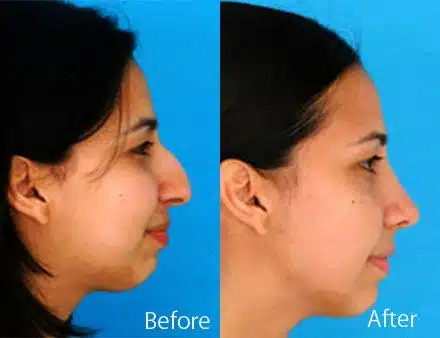 Ethnic Rhinoplasty Before and After Photos in Sewell, NJ, Patient 7161