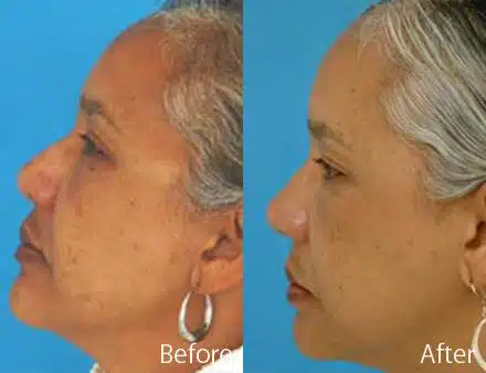 Ethnic Rhinoplasty Before and After Photos in Sewell, NJ, Patient 7163