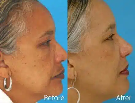 Ethnic Rhinoplasty Before and After Photos in Sewell, NJ