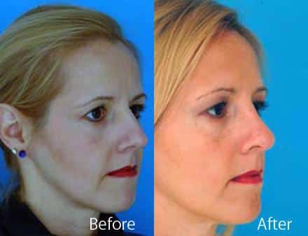 Finesse Rhinoplasty Before and After Photos in Sewell, NJ, Patient 7190