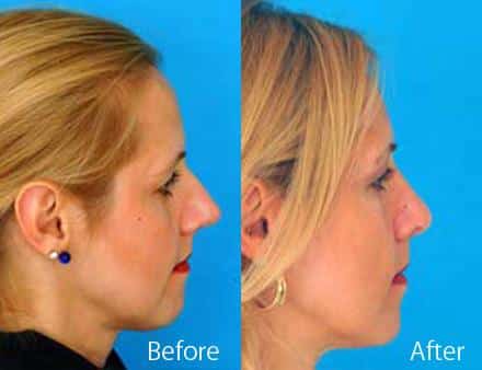 Finesse Rhinoplasty Before and After Photos in Sewell, NJ, Patient 7190