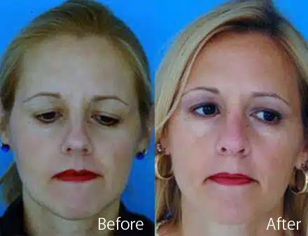 Finesse Rhinoplasty Before and After Photos in Sewell, NJ, Patient 7190