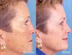 Finesse Rhinoplasty Before and After Photos in Sewell, NJ, Patient 7194