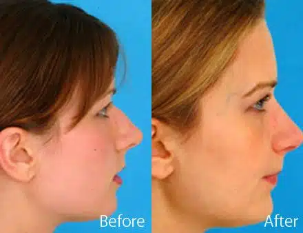 Finesse Rhinoplasty Before and After Photos in Sewell, NJ, Patient 7198