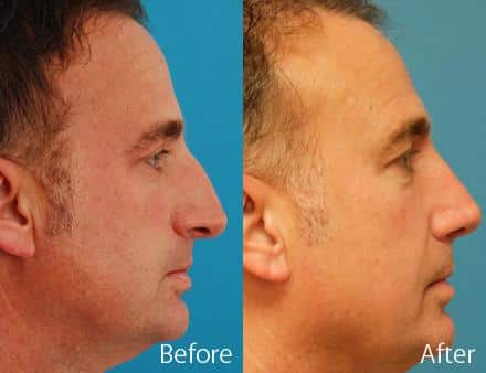 Nasal Bump Before and After Photos in Sewell, NJ, Patient 7212