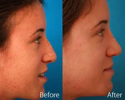 Nasal Bump Before and After Photos in Sewell, NJ, Patient 7214