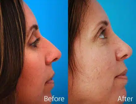 Nasal Bump Before and After Photos in Sewell, NJ, Patient 7218