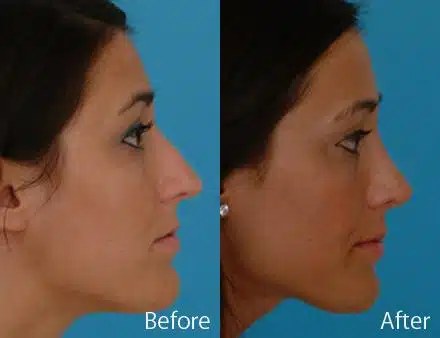 Nasal Bump Before and After Photos in Sewell, NJ, Patient 7227