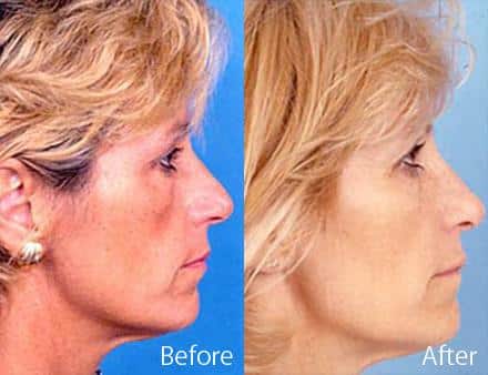 Nasal Bump Before and After Photos in Sewell, NJ, Patient 7235