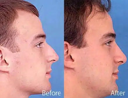 Nasal Bump Before and After Photos in Sewell, NJ, Patient 7238