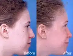 Nasal Bump Before and After Photos in Sewell, NJ, Patient 7274