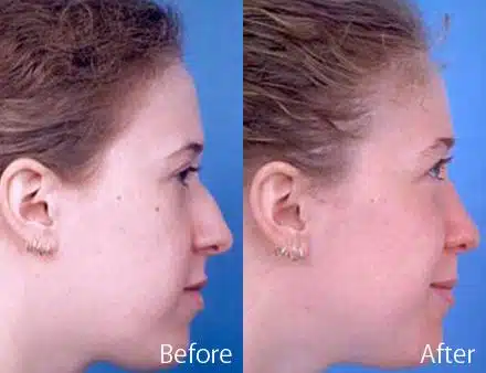 Nasal Bump Before and After Photos in Sewell, NJ, Patient 7274