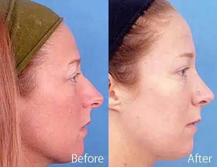 Nasal Bump Before and After Photos in Sewell, NJ, Patient 7276