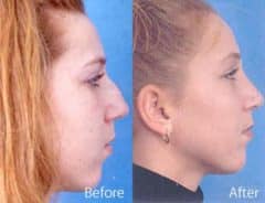 Nasal Bump Before and After Photos in Sewell, NJ, Patient 7284