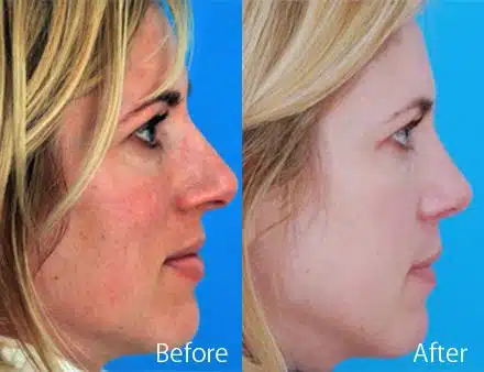 Nasal Bump Before and After Photos in Sewell, NJ, Patient 7286