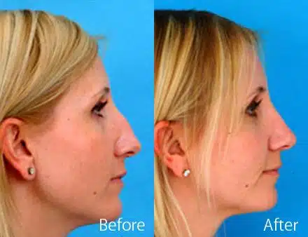 Nasal Bump Before and After Photos in Sewell, NJ, Patient 7291