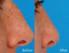 Nasal Bump Before and After Photos in Sewell, NJ, Patient 7315