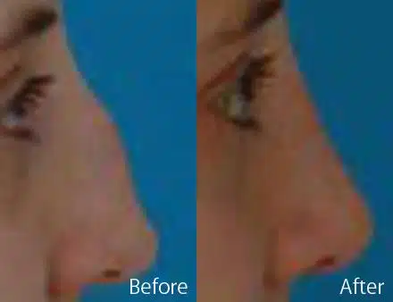 Nasal Bump Before and After Photos in Sewell, NJ, Patient 7321