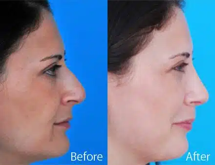 Nasal Bump Before and After Photos in Sewell, NJ, Patient 7325