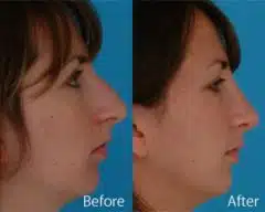 Nasal Bump Before and After Photos in Sewell, NJ, Patient 7328