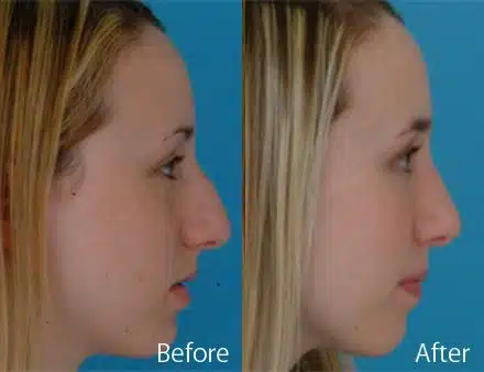 Nasal Bump Before and After Photos in Sewell, NJ, Patient 7330