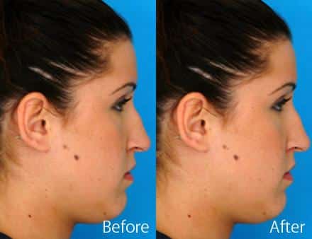 Nasal Bump Before and After Photos in Sewell, NJ, Patient 7336