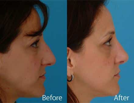 Nasal Bump Before and After Photos in Sewell, NJ, Patient 7338